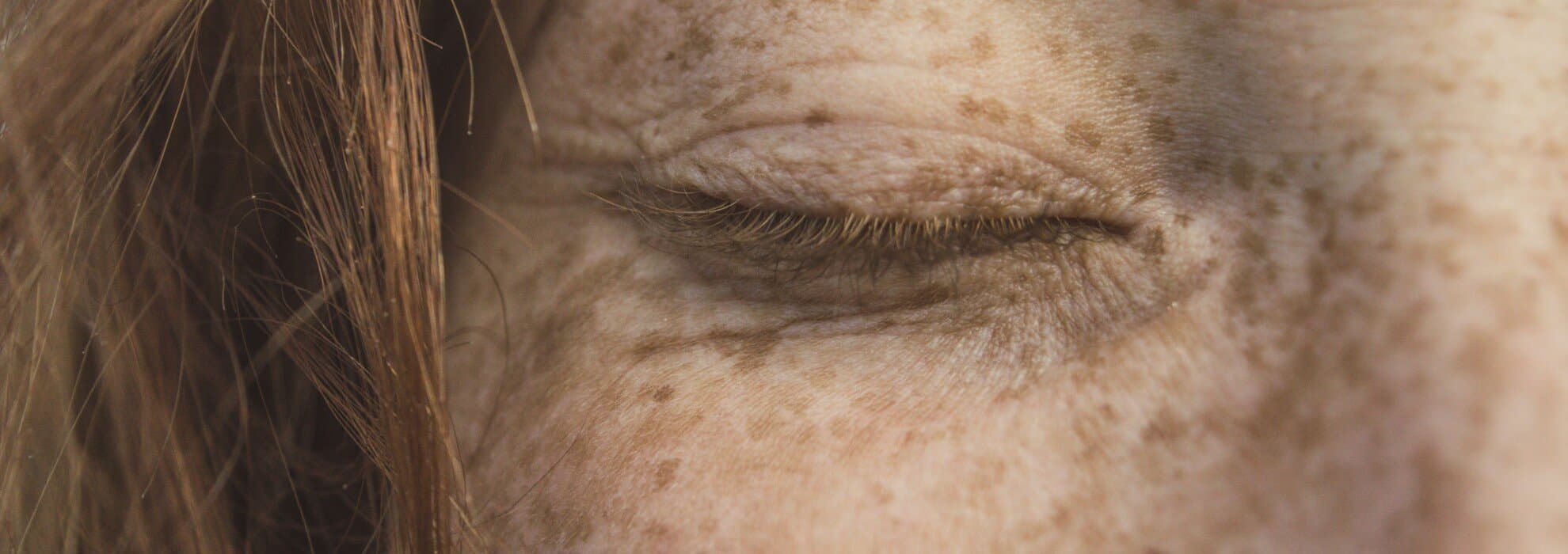 bild på hudförändringar