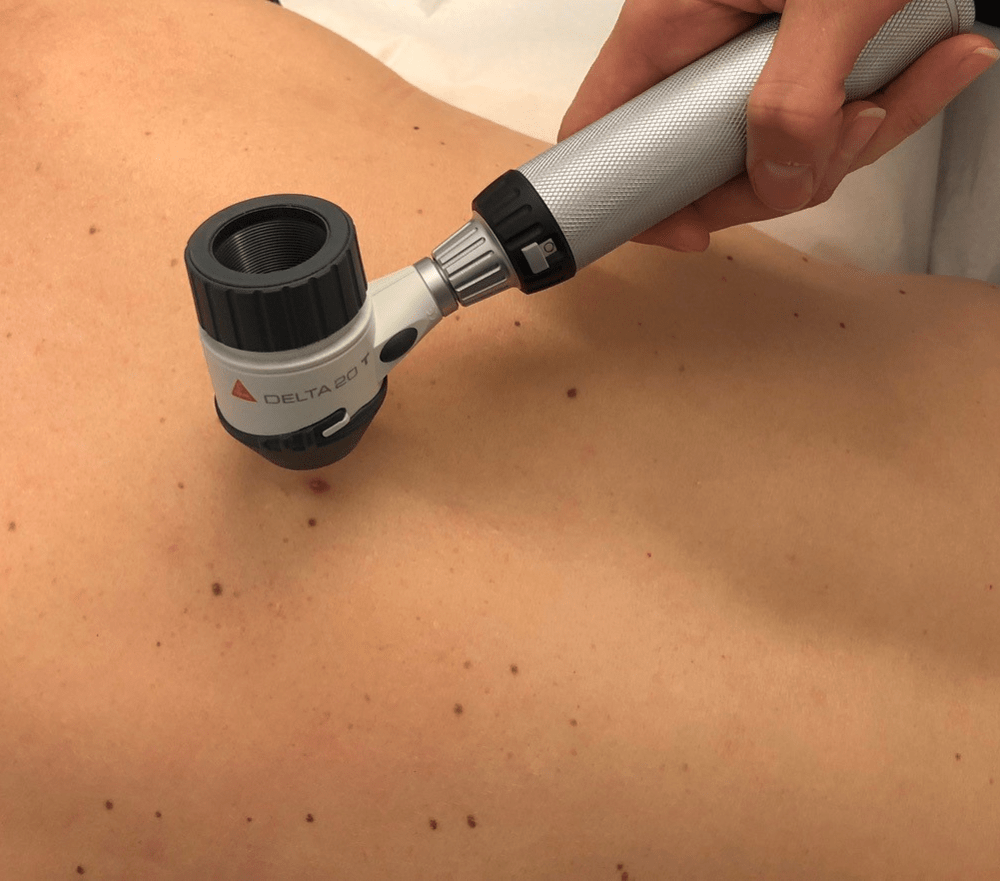 Dermatoskopundersökning av hud